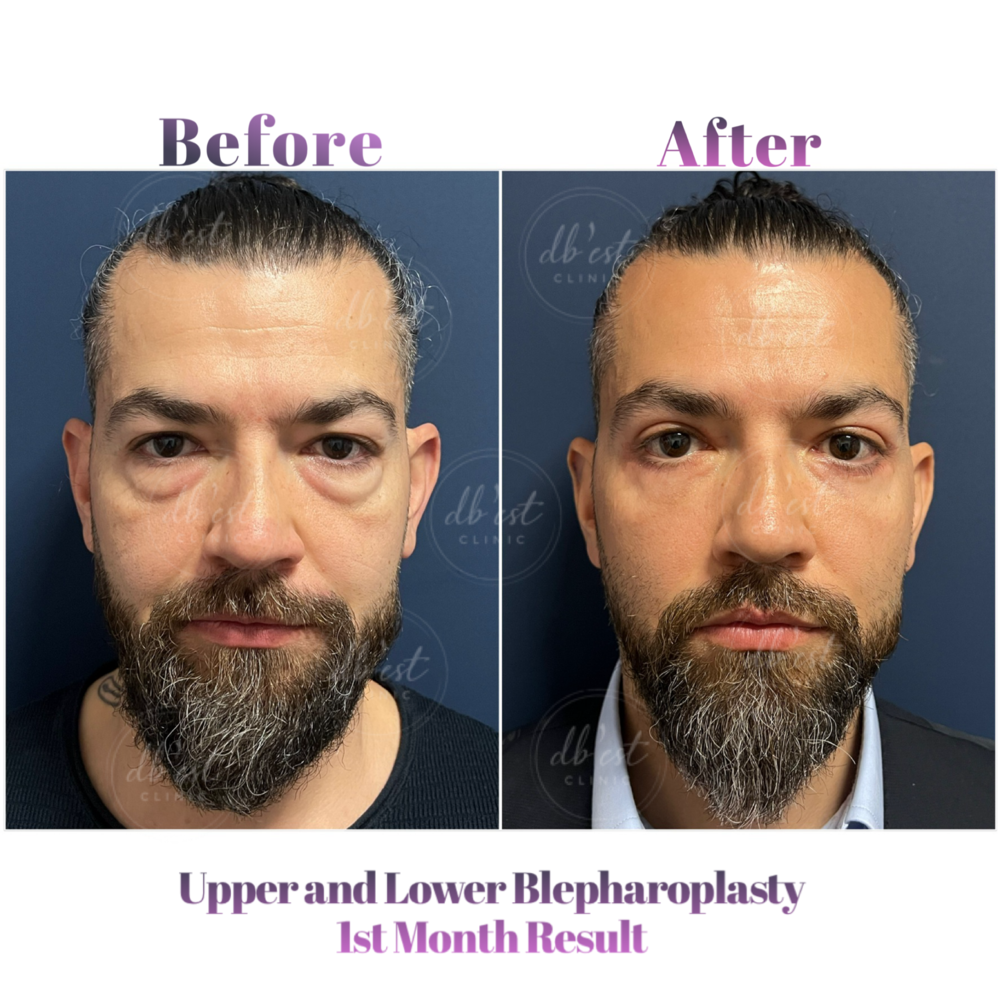 Before and After Result